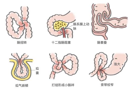 绞窄性肠梗阻图片